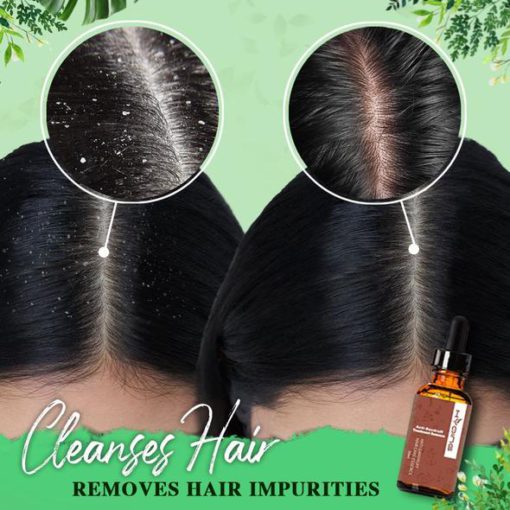 Essence for treating dandruff
