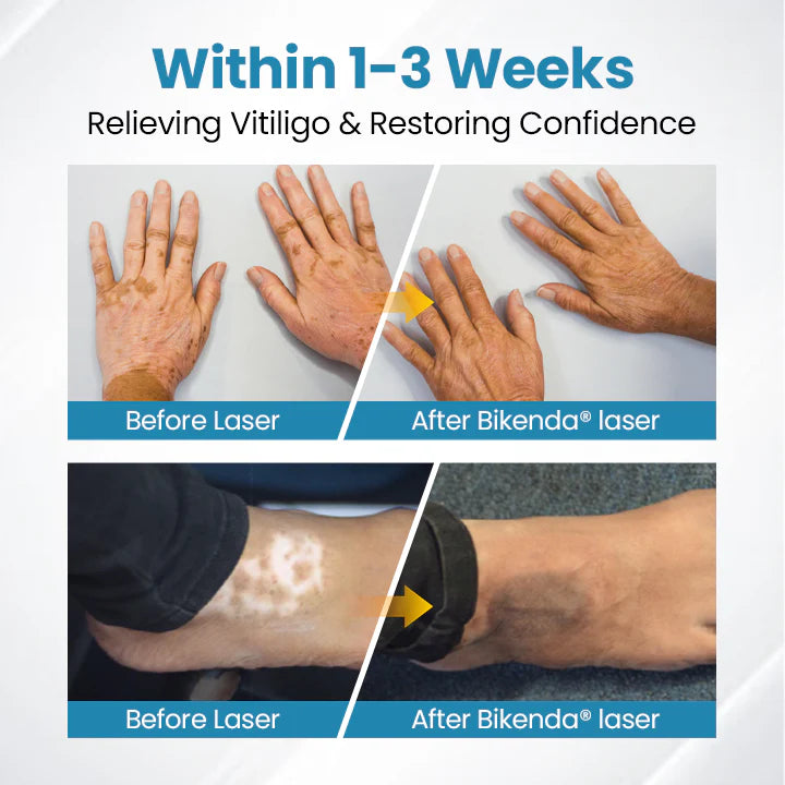 💥Biikenda® DermaBeam Vitiligo Therapy Device⏳Limited-time 49% off⏰💥