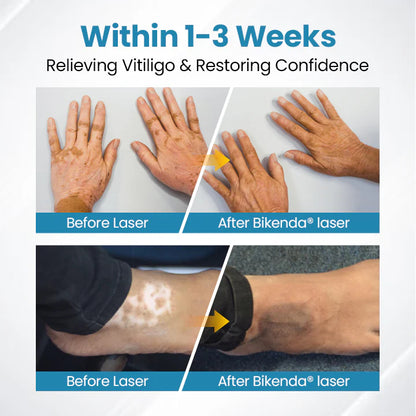 💥Biikenda® DermaBeam Vitiligo Therapy Device⏳Limited-time 49% off⏰💥
